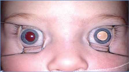 FIGURE 1. CHILD WITH RETINOBLASTOMA IN THE LEFT EYE AND A WHITE PUPIL REFLEX ON FLASH PHOTOGRAPHY.